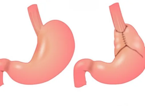 Fundoplication - Laparoscopic GERD Surgery consultation at Niraaya Hospital